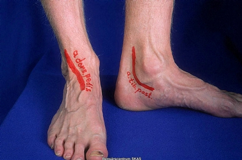 Arteria dorsalis pedis Sårwebben