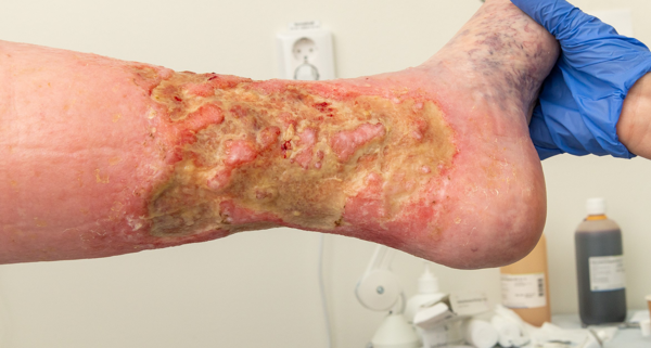 Biofilmsbeläggning på ankel