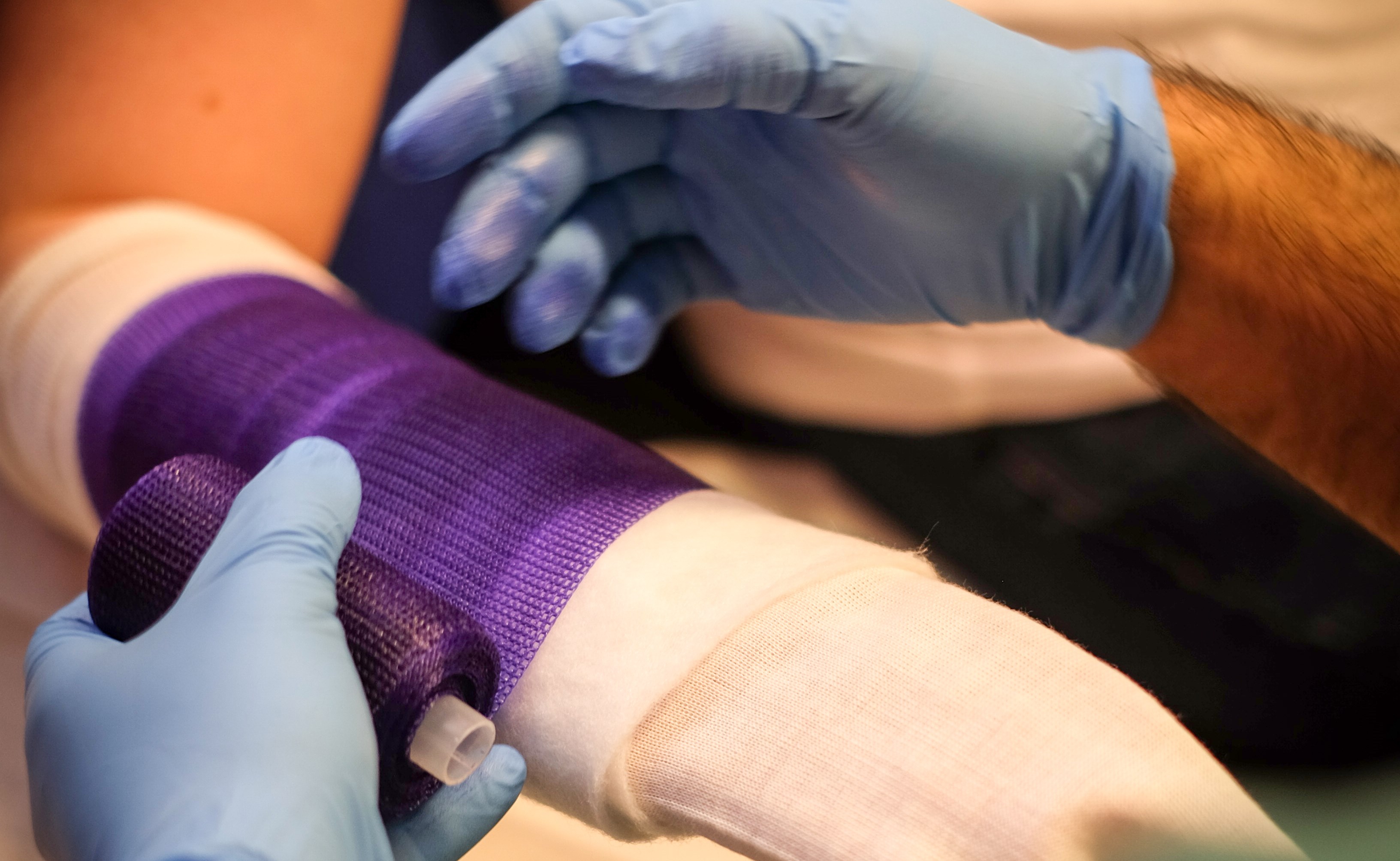 Patient får gips på ortopedisk mottagning.