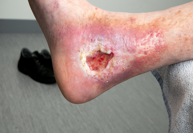 Atrofie blanche och venöst sår